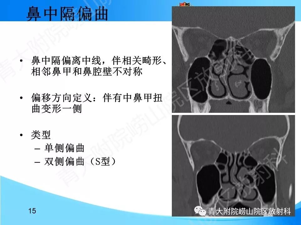 影像PPT - 【PPT】鼻中隔解剖及发育变异-15