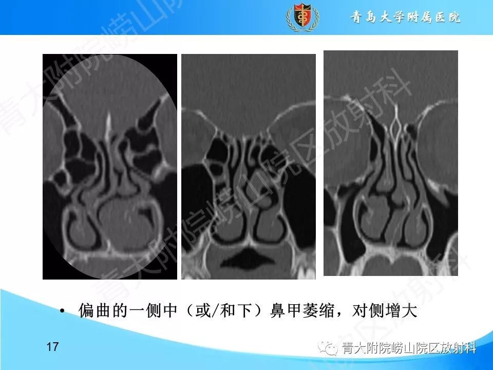 影像PPT - 【PPT】鼻中隔解剖及发育变异-17