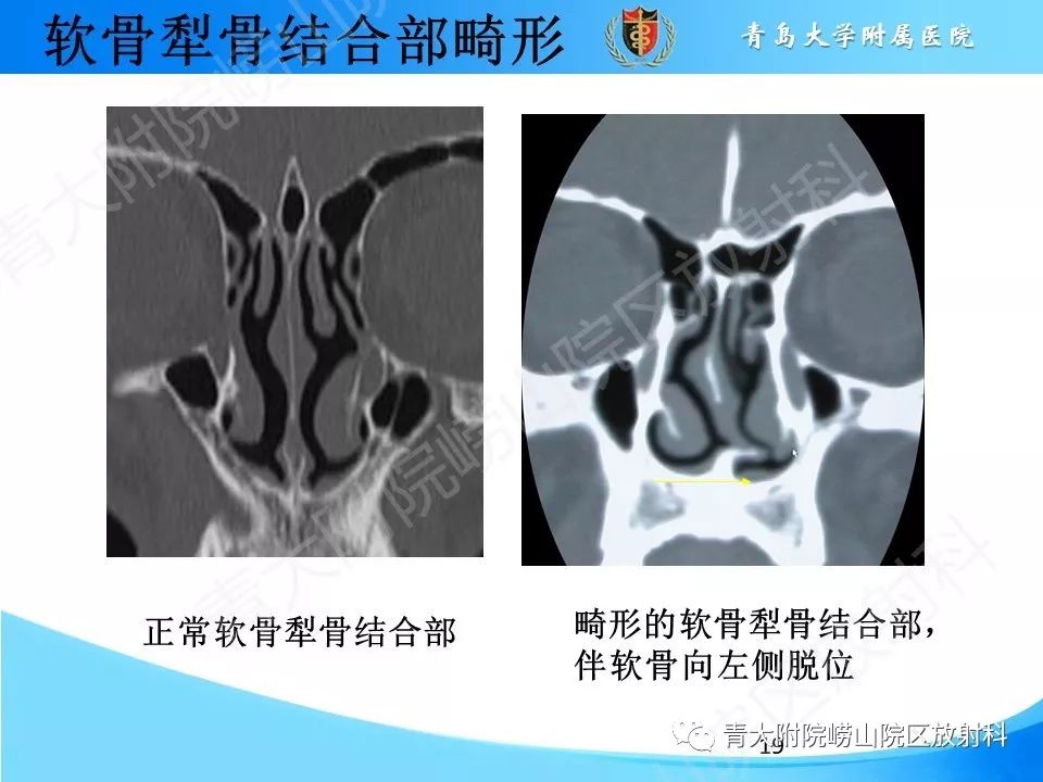 影像PPT - 【PPT】鼻中隔解剖及发育变异-19