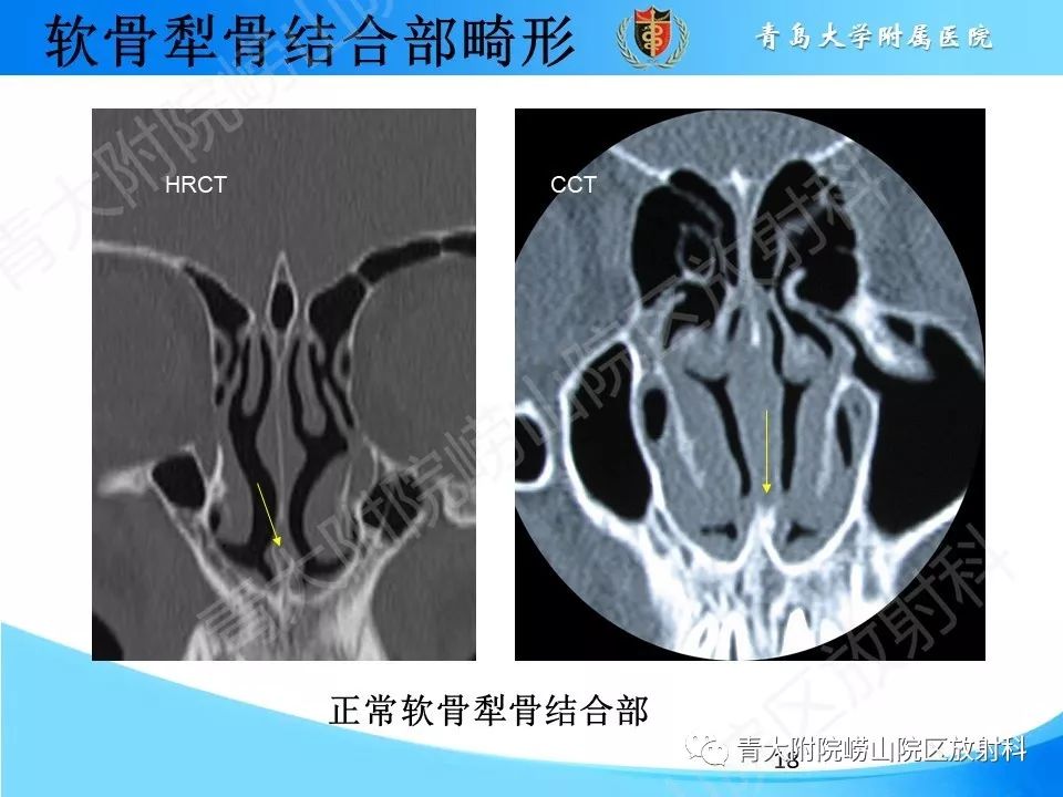 影像PPT - 【PPT】鼻中隔解剖及发育变异-18
