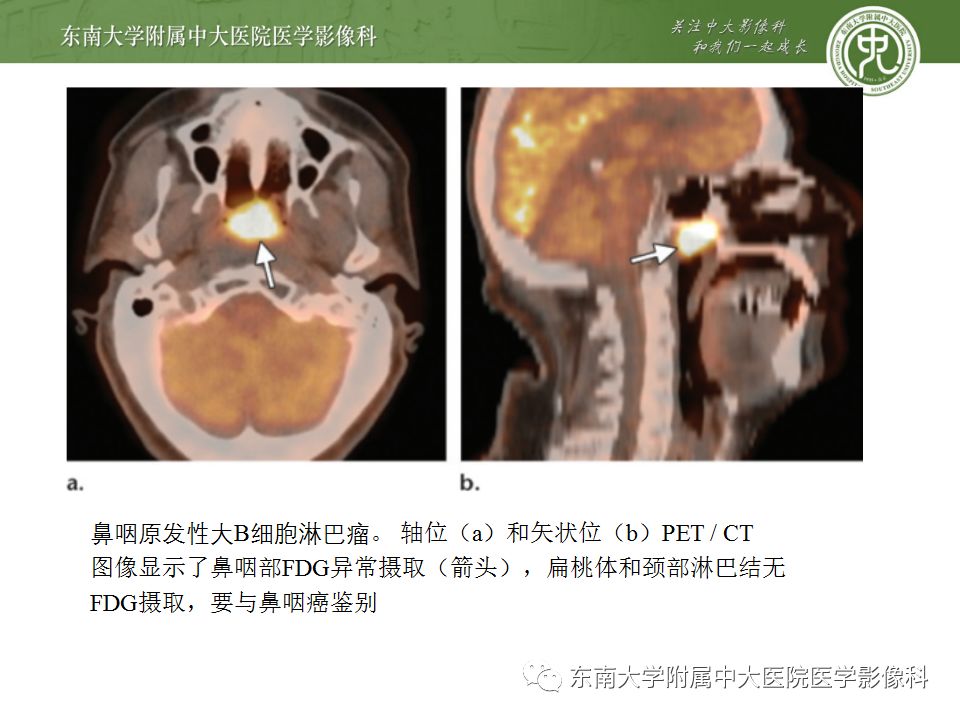 影像PPT - 【PPT】鼻咽部淋巴瘤-18