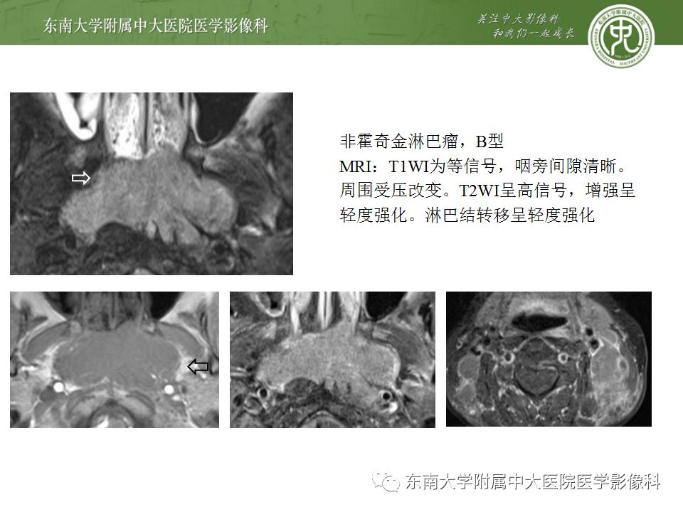 影像PPT - 【PPT】鼻咽部淋巴瘤-19