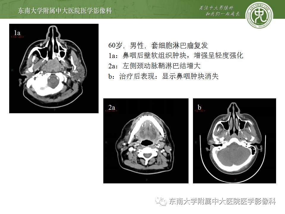 影像PPT - 【PPT】鼻咽部淋巴瘤-20