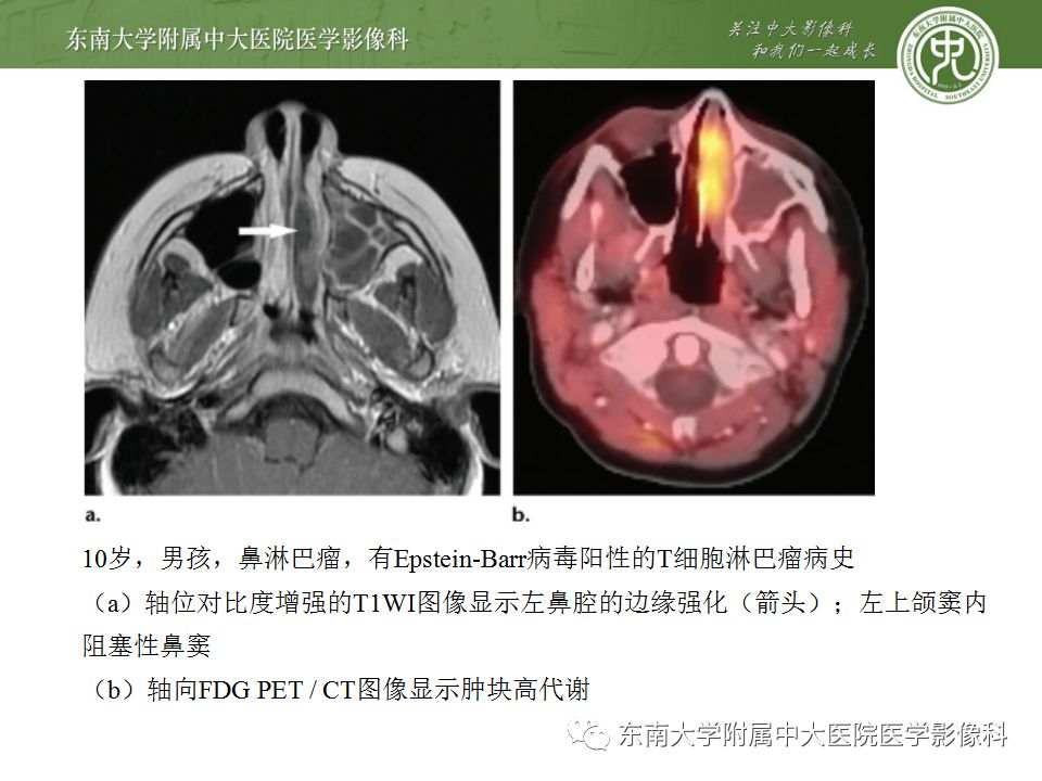 影像PPT - 【PPT】鼻咽部淋巴瘤-24