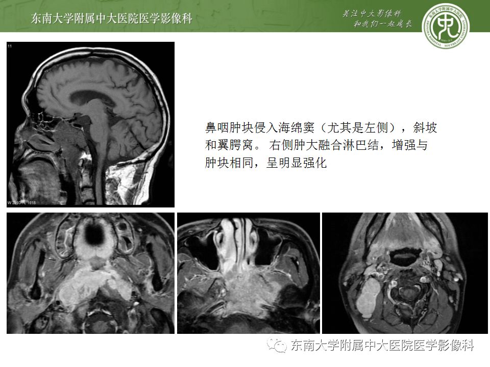 影像PPT - 【PPT】鼻咽部淋巴瘤-28