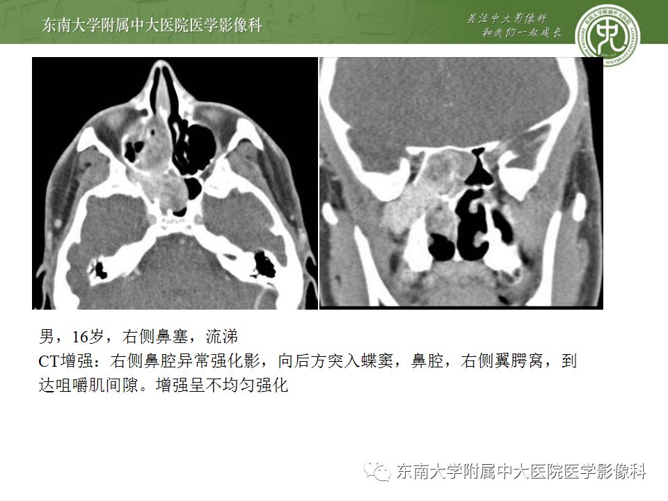 影像PPT - 【PPT】鼻咽部淋巴瘤-32