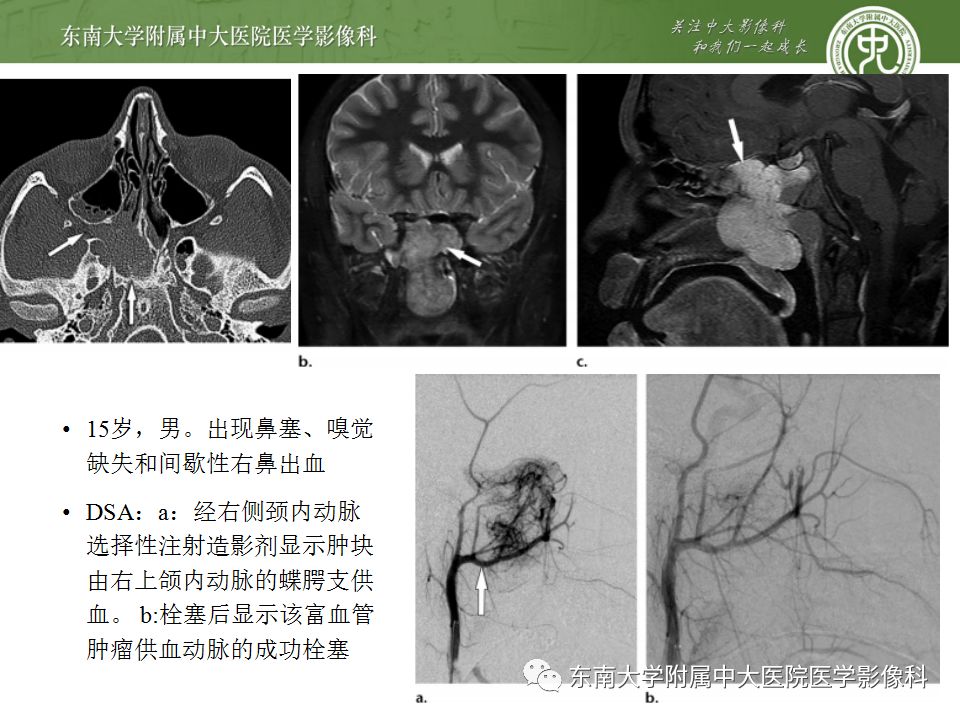 影像PPT - 【PPT】鼻咽部淋巴瘤-31