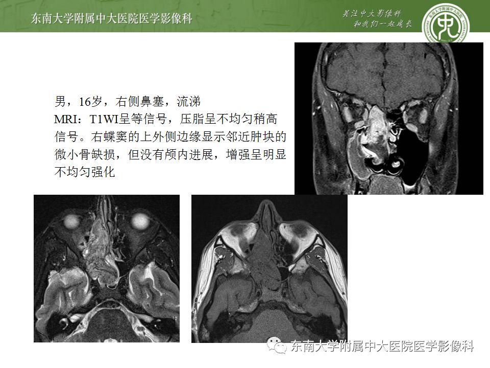 影像PPT - 【PPT】鼻咽部淋巴瘤-33