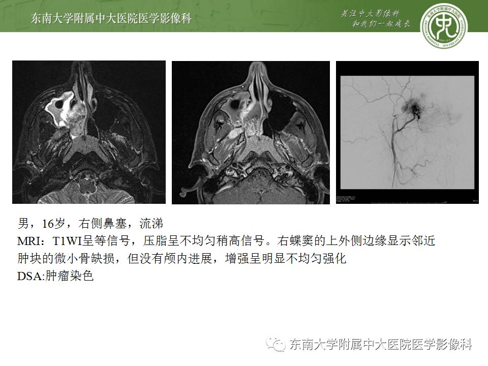 影像PPT - 【PPT】鼻咽部淋巴瘤-34