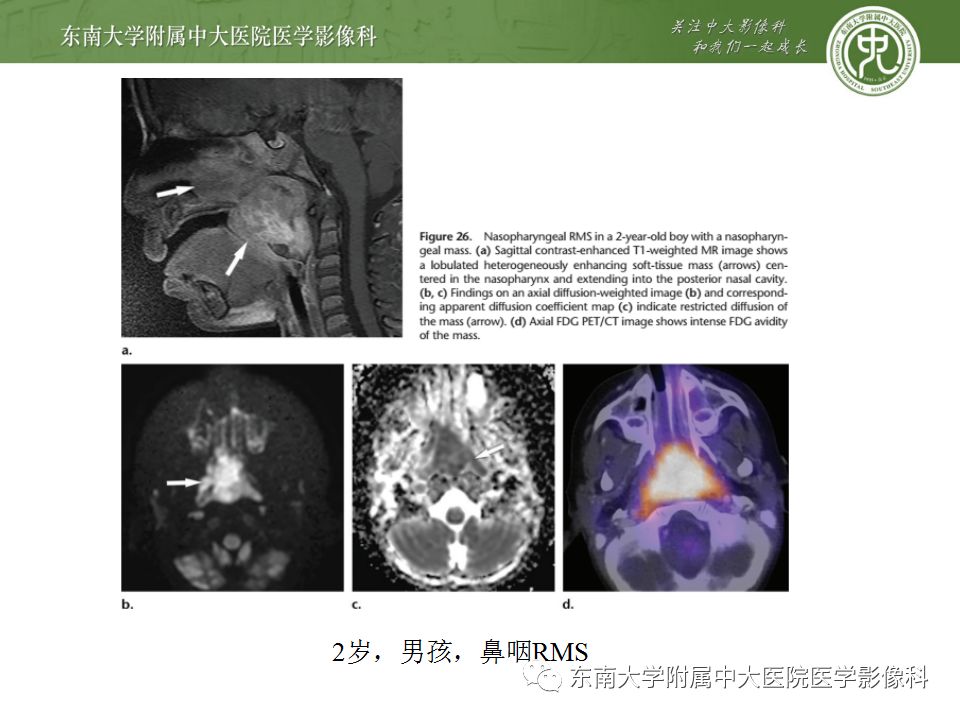 影像PPT - 【PPT】鼻咽部淋巴瘤-37