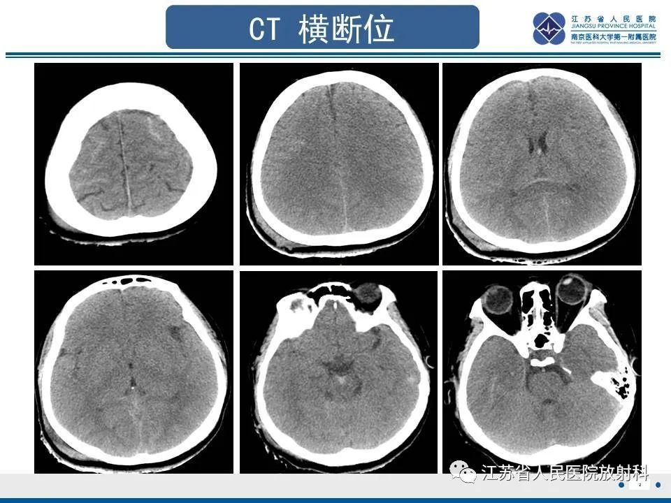 影像PPT - 【PPT】弥漫性轴索损伤-3