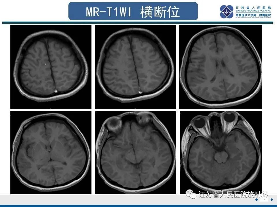 影像PPT - 【PPT】弥漫性轴索损伤-4