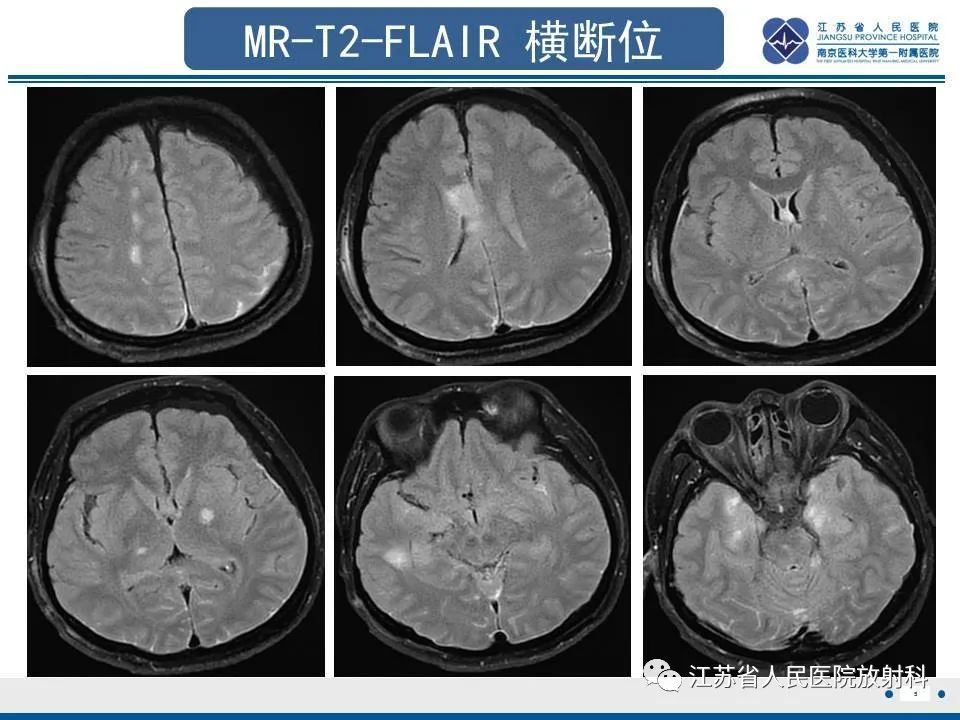 影像PPT - 【PPT】弥漫性轴索损伤-6