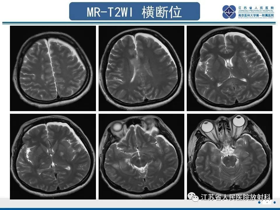 影像PPT - 【PPT】弥漫性轴索损伤-5