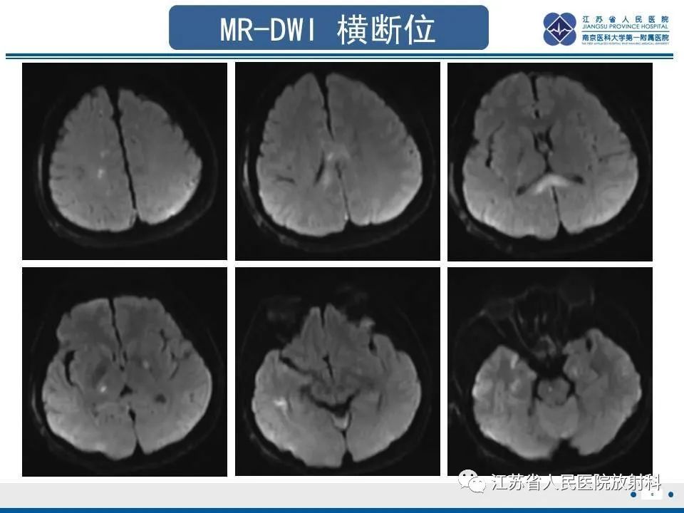 影像PPT - 【PPT】弥漫性轴索损伤-7