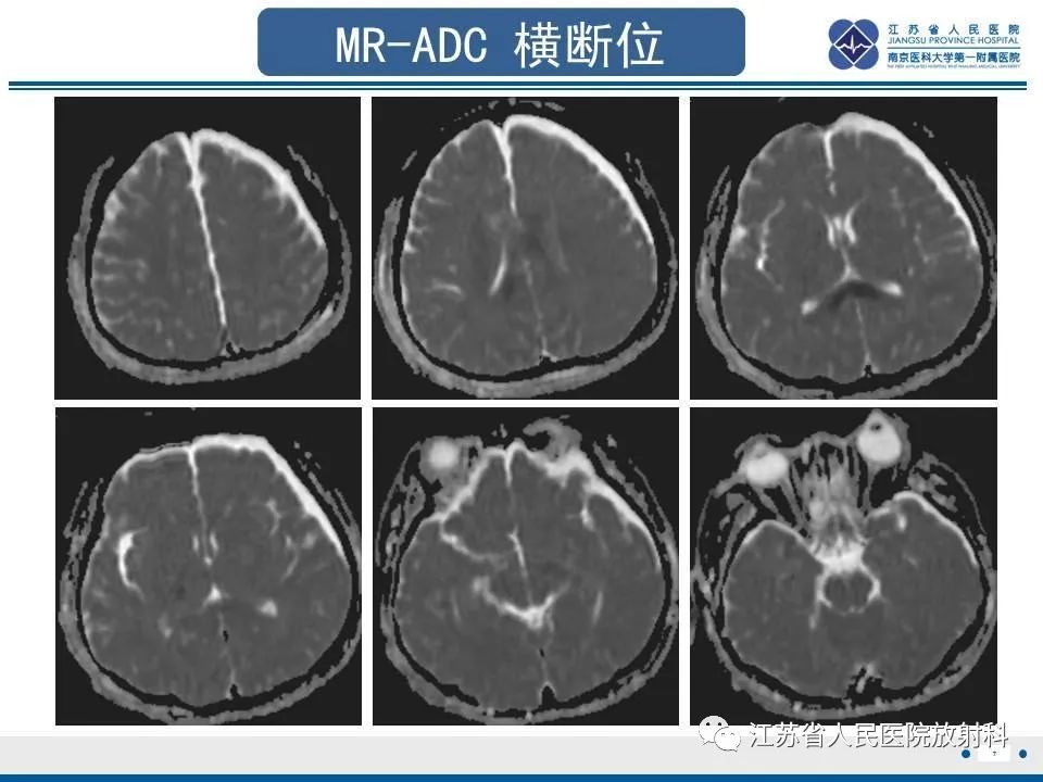 影像PPT - 【PPT】弥漫性轴索损伤-8