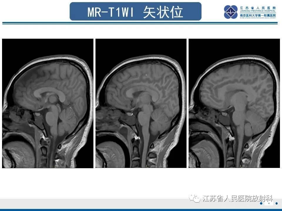 影像PPT - 【PPT】弥漫性轴索损伤-9