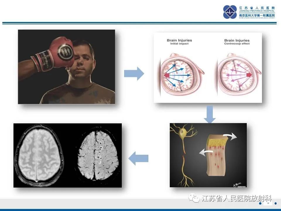 影像PPT - 【PPT】弥漫性轴索损伤-18