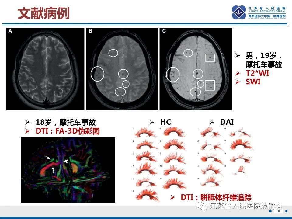 影像PPT - 【PPT】弥漫性轴索损伤-24