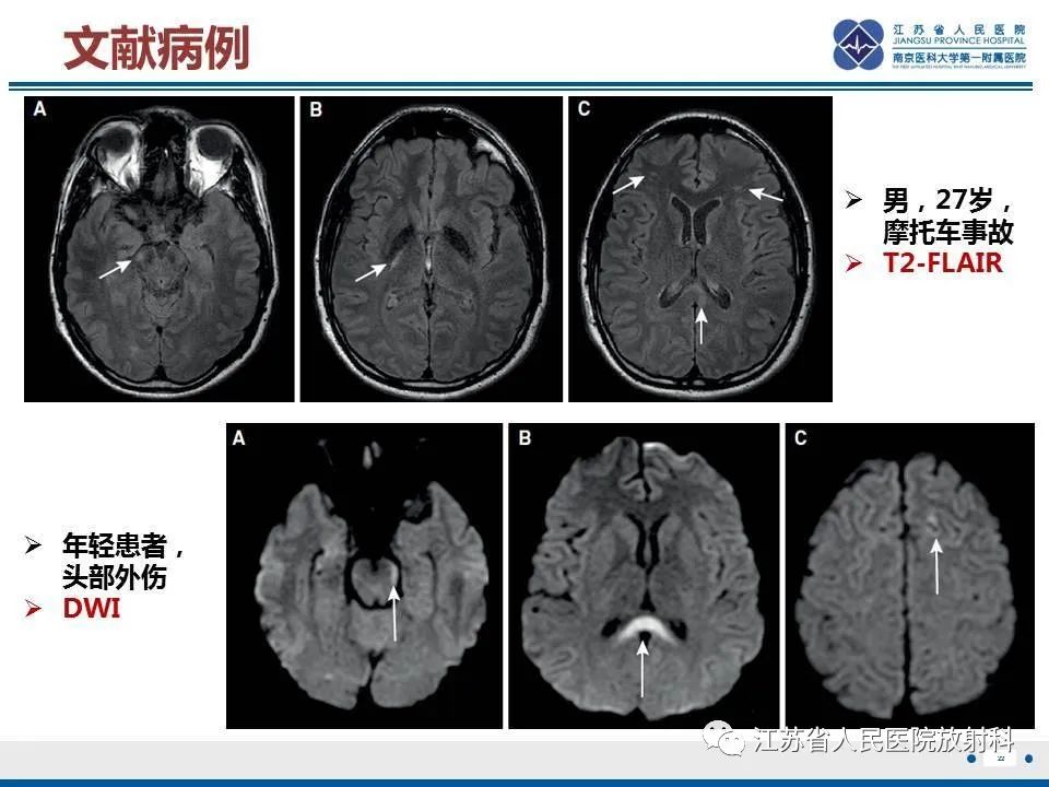影像PPT - 【PPT】弥漫性轴索损伤-23