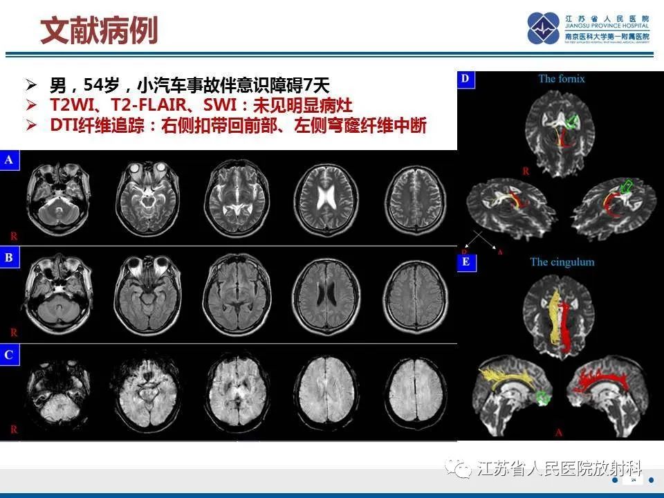 影像PPT - 【PPT】弥漫性轴索损伤-25