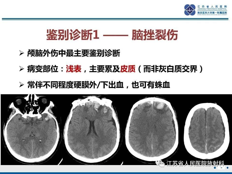 影像PPT - 【PPT】弥漫性轴索损伤-29