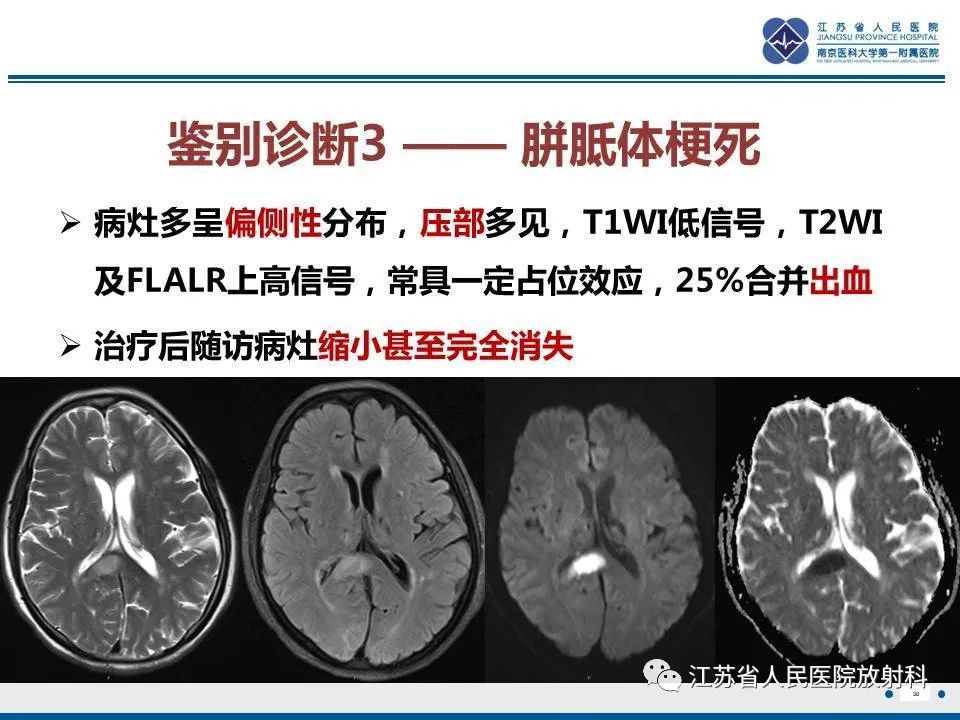 影像PPT - 【PPT】弥漫性轴索损伤-31