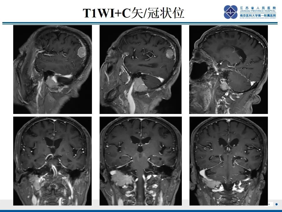 影像PPT - 【PPT】孤立性骨浆细胞瘤-7