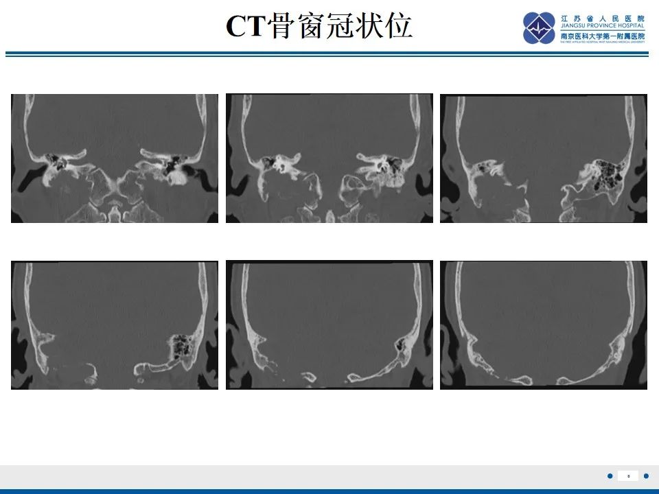 影像PPT - 【PPT】孤立性骨浆细胞瘤-9