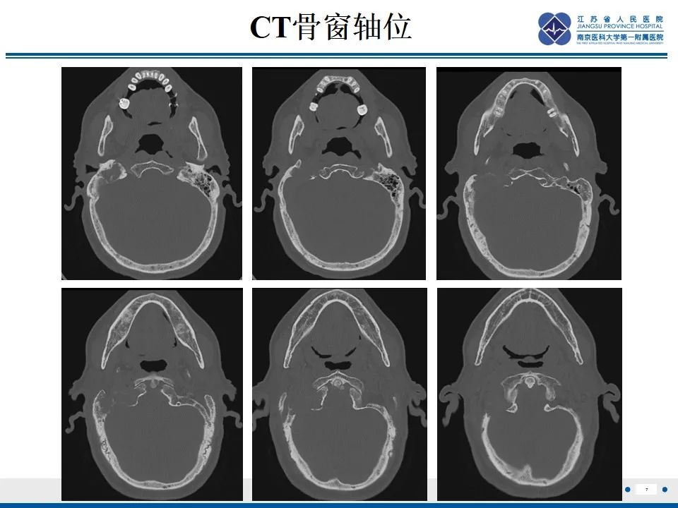 影像PPT - 【PPT】孤立性骨浆细胞瘤-8