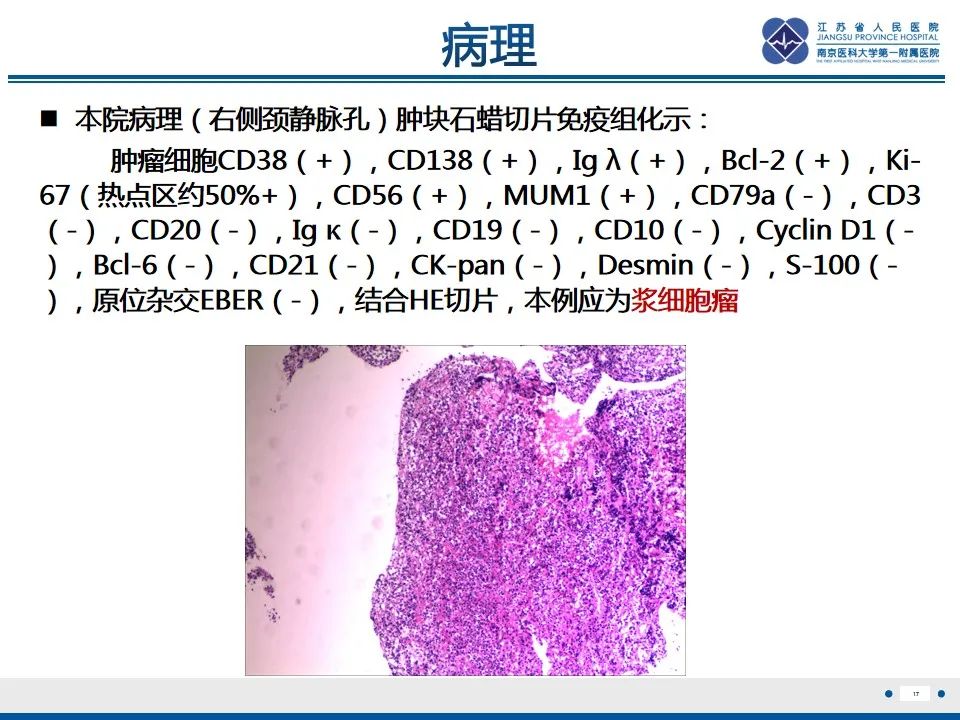 影像PPT - 【PPT】孤立性骨浆细胞瘤-18