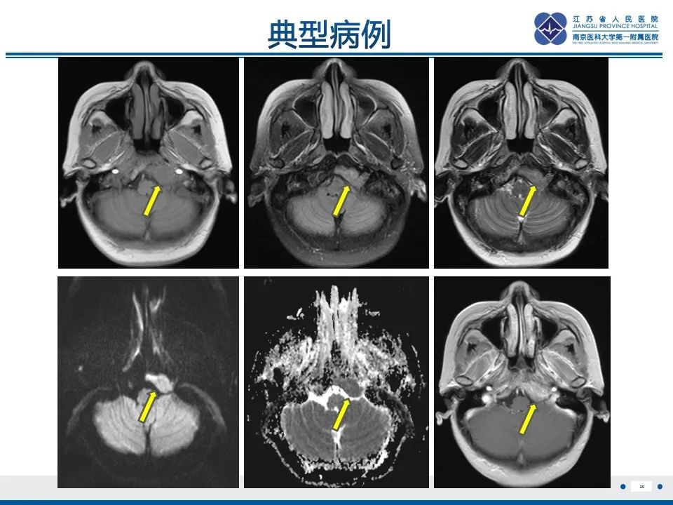 影像PPT - 【PPT】孤立性骨浆细胞瘤-21