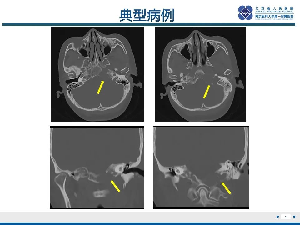 影像PPT - 【PPT】孤立性骨浆细胞瘤-22