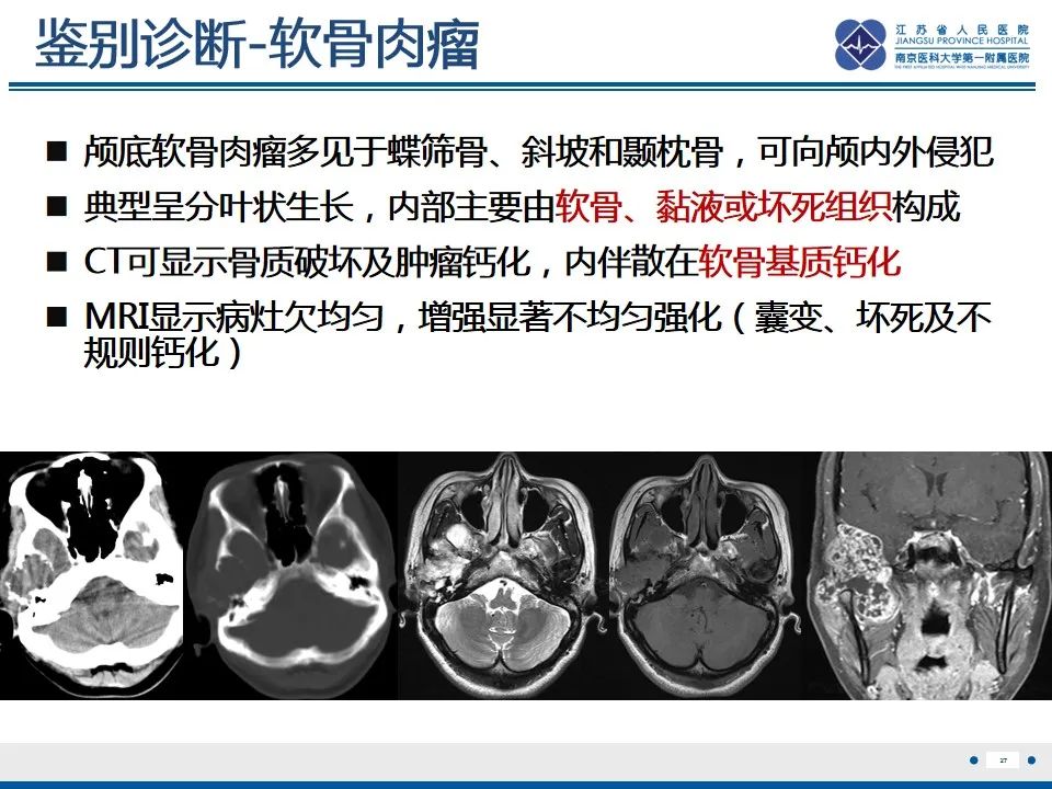 影像PPT - 【PPT】孤立性骨浆细胞瘤-28