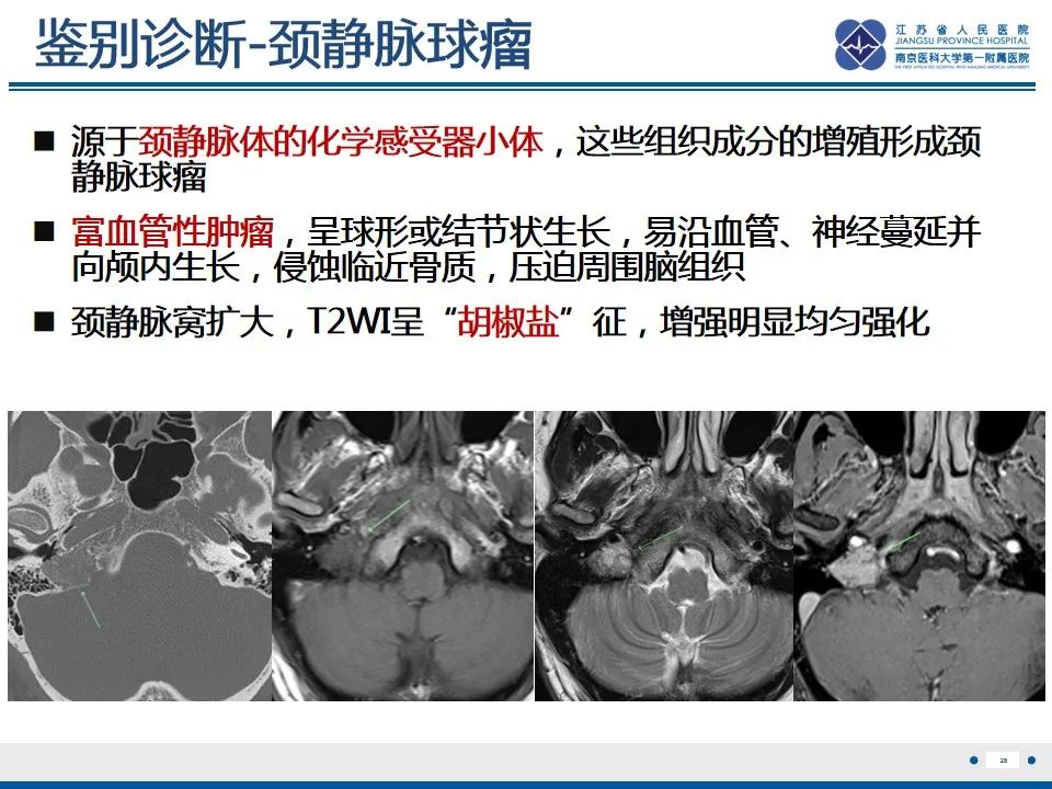 影像PPT - 【PPT】孤立性骨浆细胞瘤-29