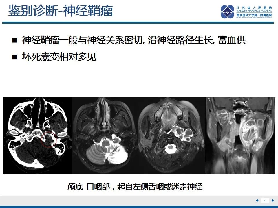 影像PPT - 【PPT】孤立性骨浆细胞瘤-30