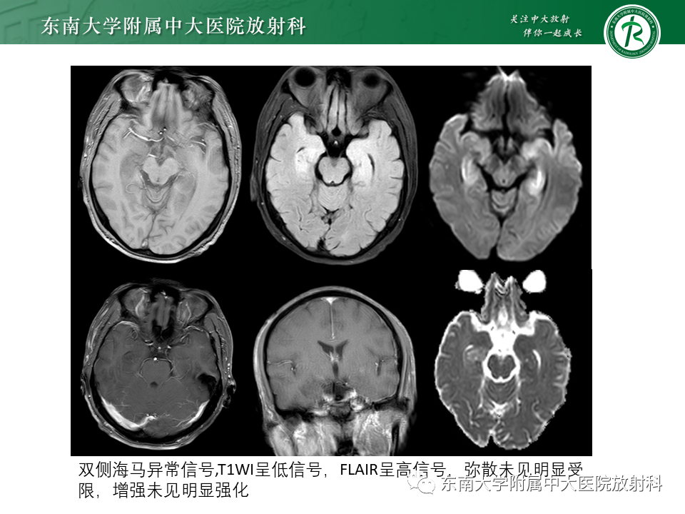 影像PPT - 【PPT】边缘性脑炎-3