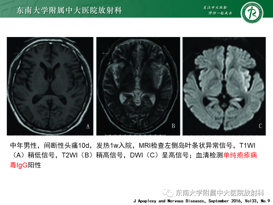 影像PPT - 【PPT】边缘性脑炎-15