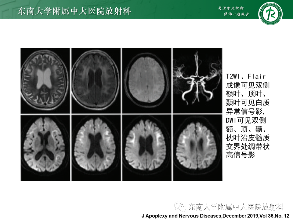 影像PPT - 【PPT】边缘性脑炎-23