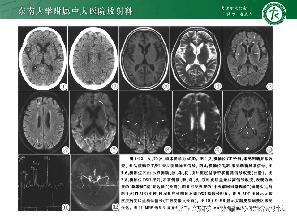 影像PPT - 【PPT】边缘性脑炎-21