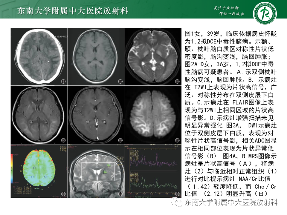 影像PPT - 【PPT】边缘性脑炎-25