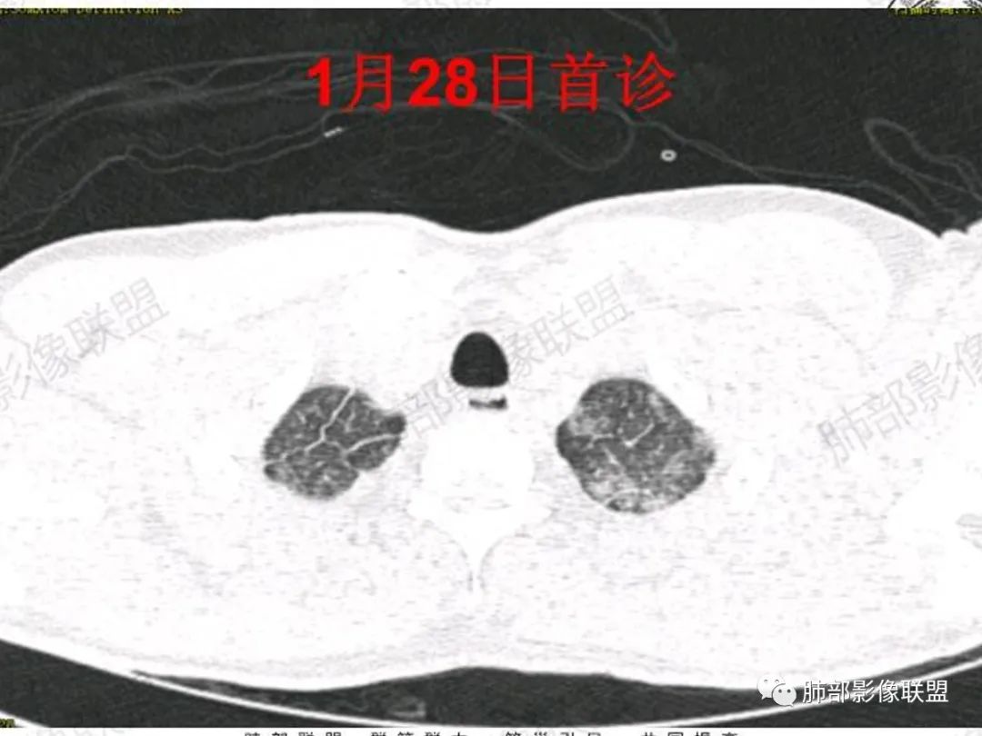 影像PPT - 【病例】“火灾肺”--急性烟雾吸入性肺损伤-3 影像PPT - 【病例】“火灾肺”--急性烟雾吸入性肺损伤-3