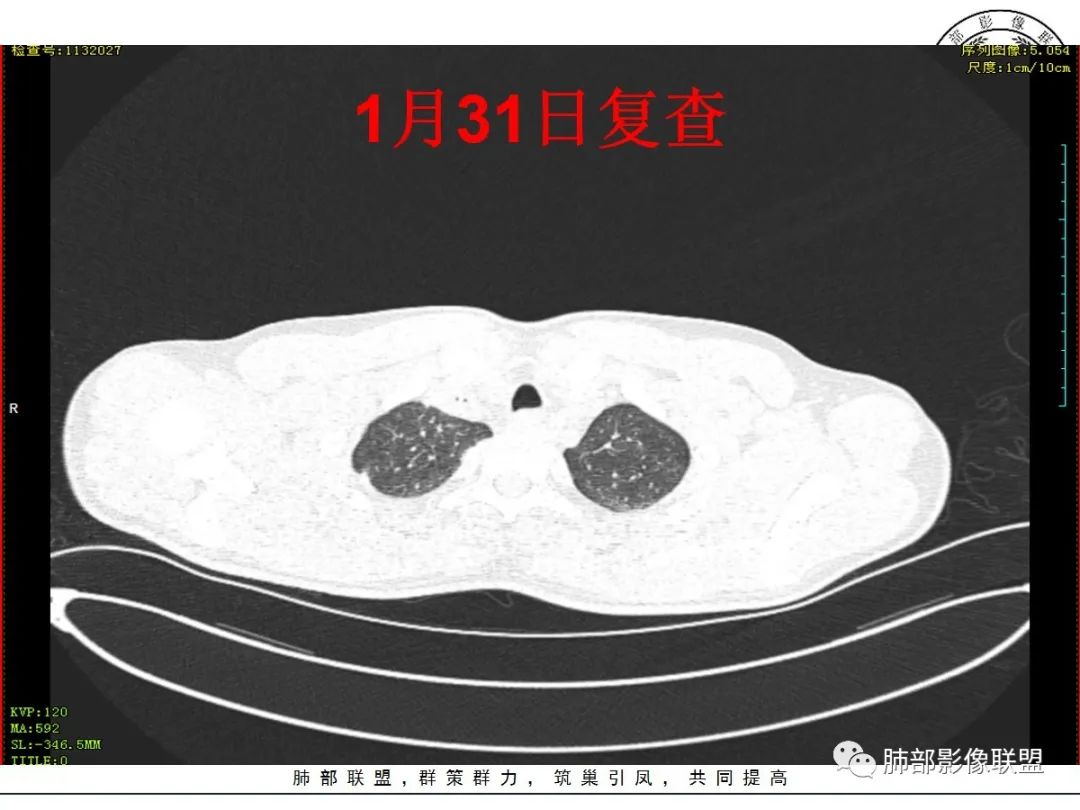 影像PPT - 【病例】“火灾肺”--急性烟雾吸入性肺损伤-35 影像PPT - 【病例】“火灾肺”--急性烟雾吸入性肺损伤-35
