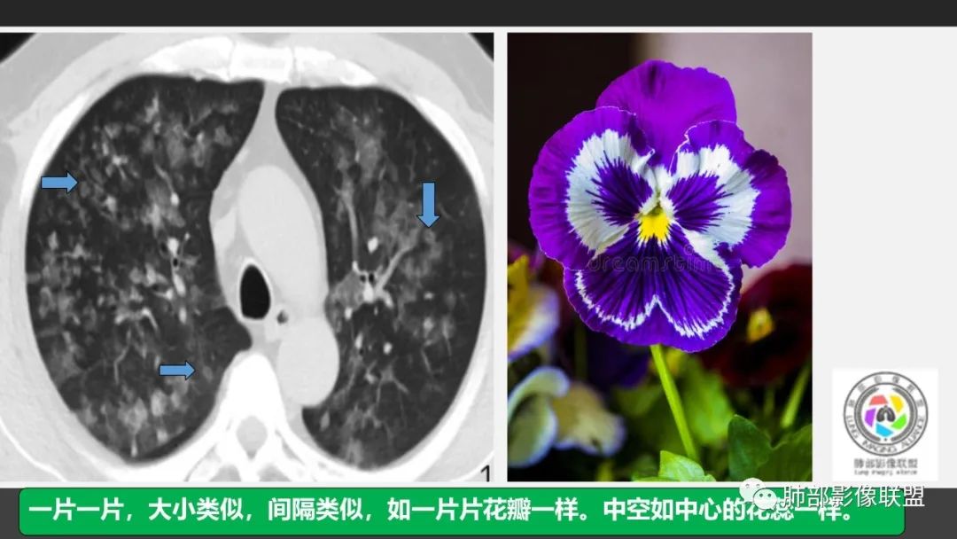 影像PPT - 【PPT】84消毒剂所致吸入性肺损伤的影像表现及其动态转归-4