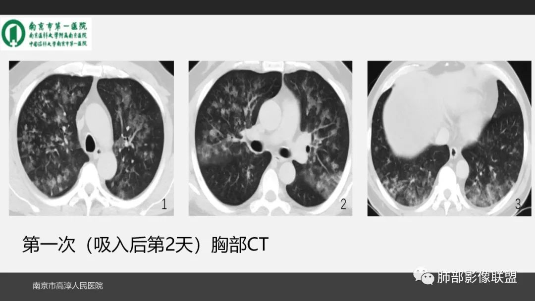 影像PPT - 【PPT】84消毒剂所致吸入性肺损伤的影像表现及其动态转归-6