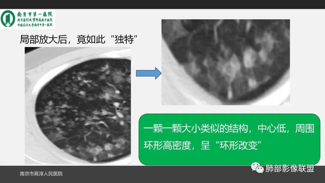影像PPT - 【PPT】84消毒剂所致吸入性肺损伤的影像表现及其动态转归-7