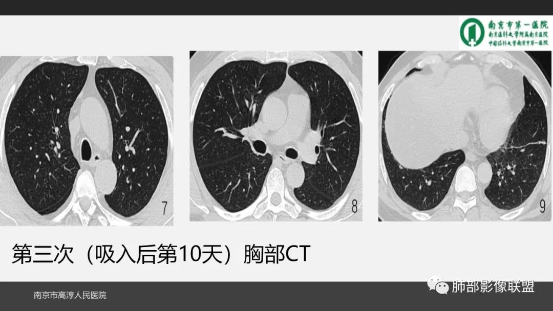 影像PPT - 【PPT】84消毒剂所致吸入性肺损伤的影像表现及其动态转归-10