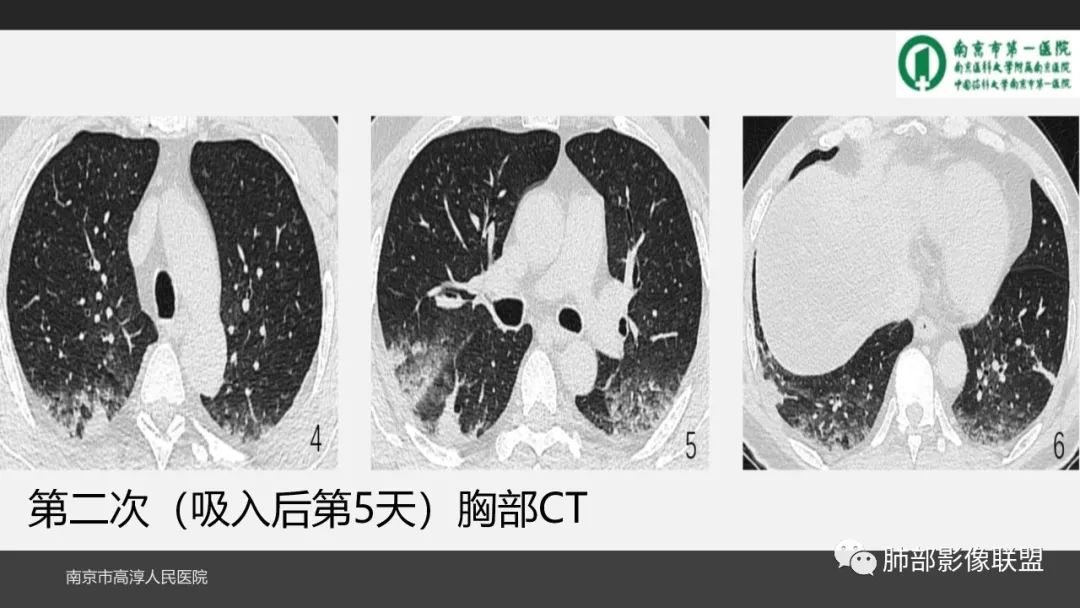 影像PPT - 【PPT】84消毒剂所致吸入性肺损伤的影像表现及其动态转归-9