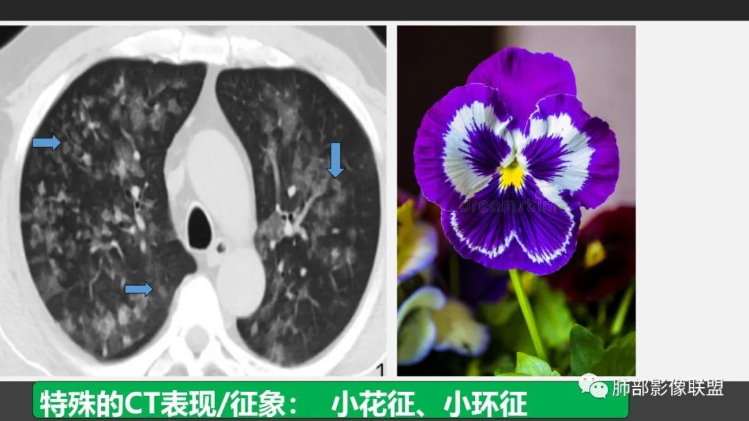 影像PPT - 【PPT】84消毒剂所致吸入性肺损伤的影像表现及其动态转归-8