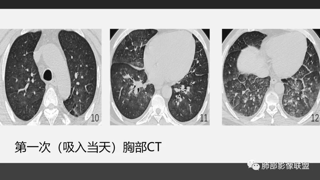 影像PPT - 【PPT】84消毒剂所致吸入性肺损伤的影像表现及其动态转归-13